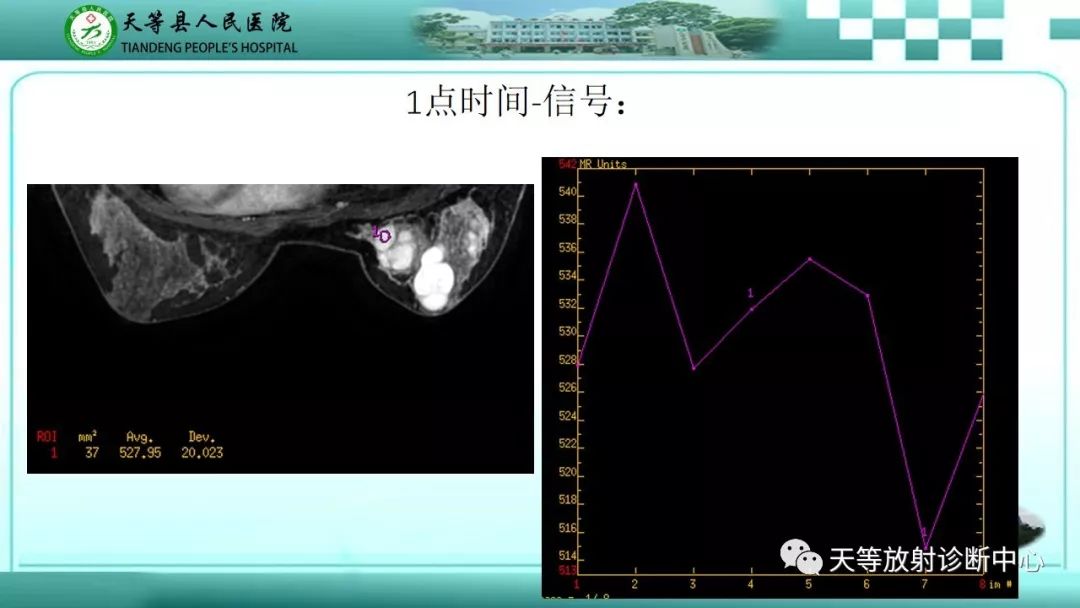 影像PPT - 【病例】乳腺纤维腺瘤1例MR影像-14 影像PPT - 【病例】乳腺纤维腺瘤1例MR影像-14