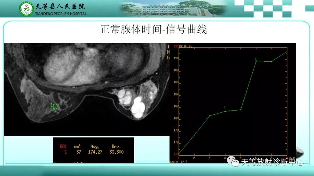 影像PPT - 【病例】乳腺纤维腺瘤1例MR影像-13 影像PPT - 【病例】乳腺纤维腺瘤1例MR影像-13