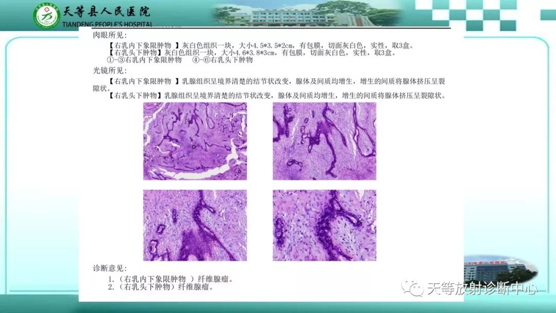 影像PPT - 【病例】乳腺纤维腺瘤1例MR影像-17 影像PPT - 【病例】乳腺纤维腺瘤1例MR影像-17