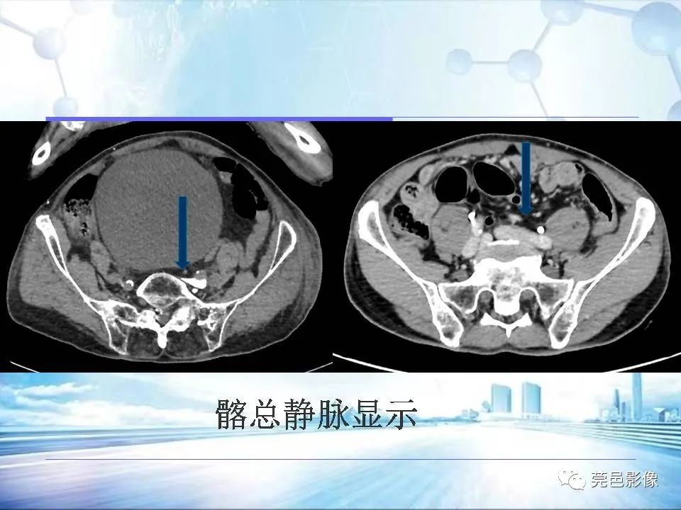 影像PPT - 【PPT】浅谈下肢静脉CTV的应用体会-17