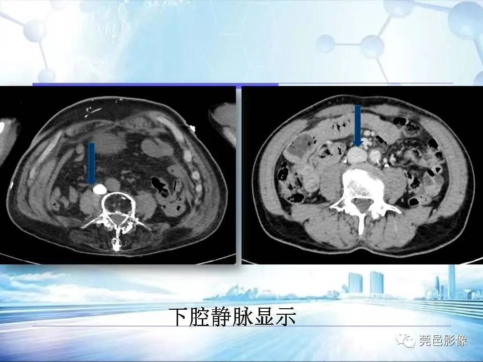 影像PPT - 【PPT】浅谈下肢静脉CTV的应用体会-16