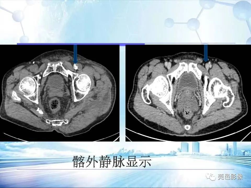 影像PPT - 【PPT】浅谈下肢静脉CTV的应用体会-18