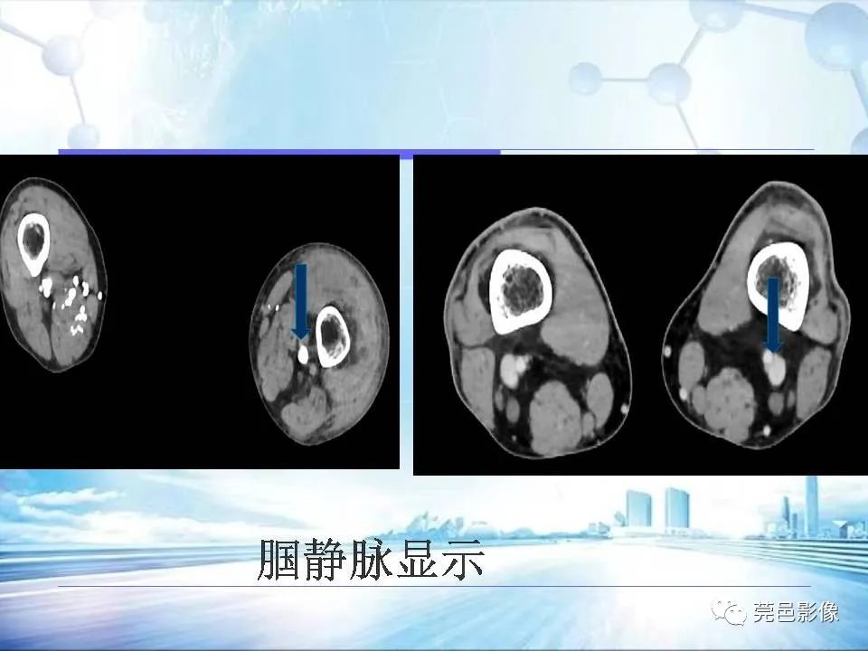 影像PPT - 【PPT】浅谈下肢静脉CTV的应用体会-20