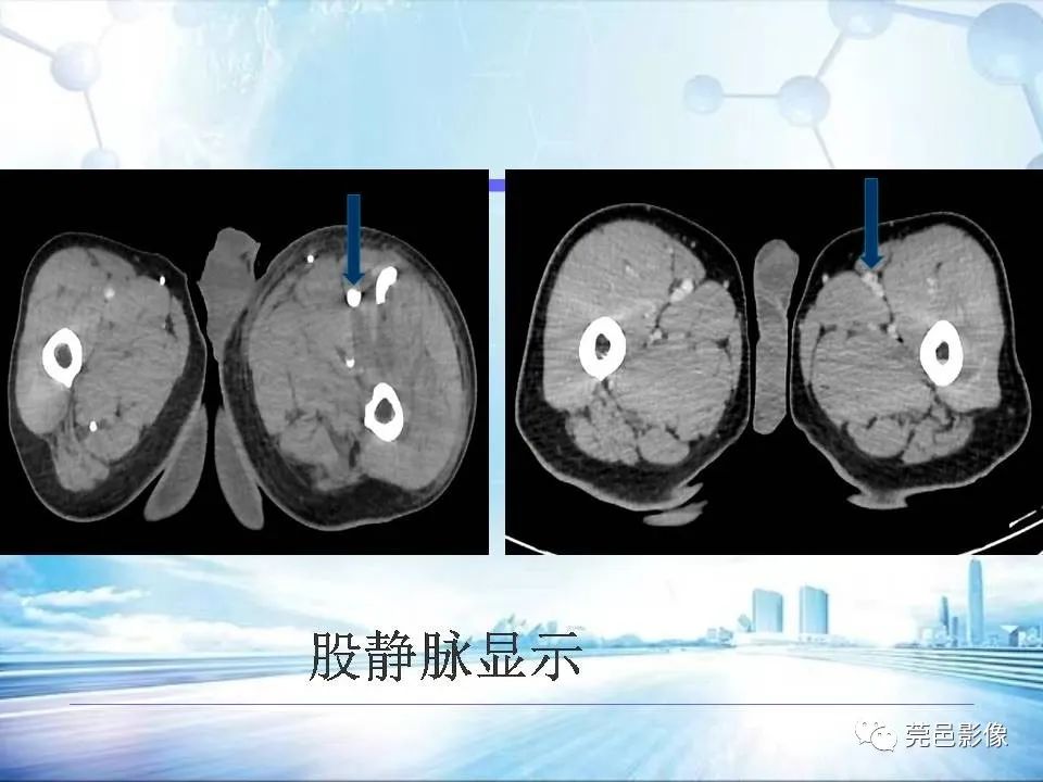 影像PPT - 【PPT】浅谈下肢静脉CTV的应用体会-19