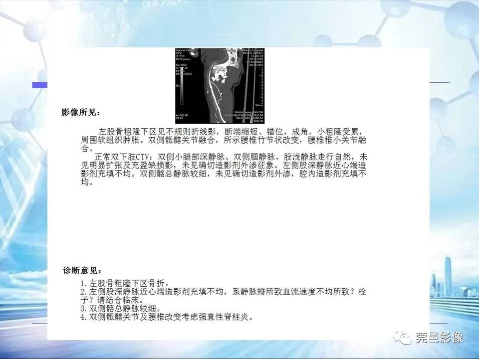 影像PPT - 【PPT】浅谈下肢静脉CTV的应用体会-24
