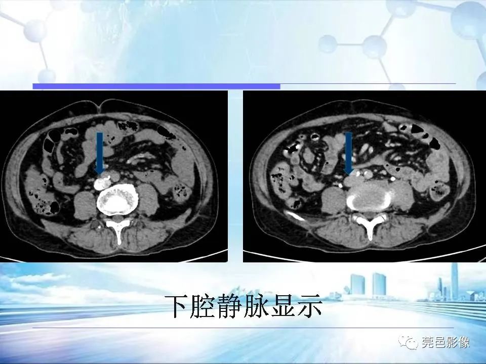 影像PPT - 【PPT】浅谈下肢静脉CTV的应用体会-26