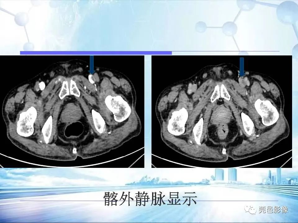 影像PPT - 【PPT】浅谈下肢静脉CTV的应用体会-28