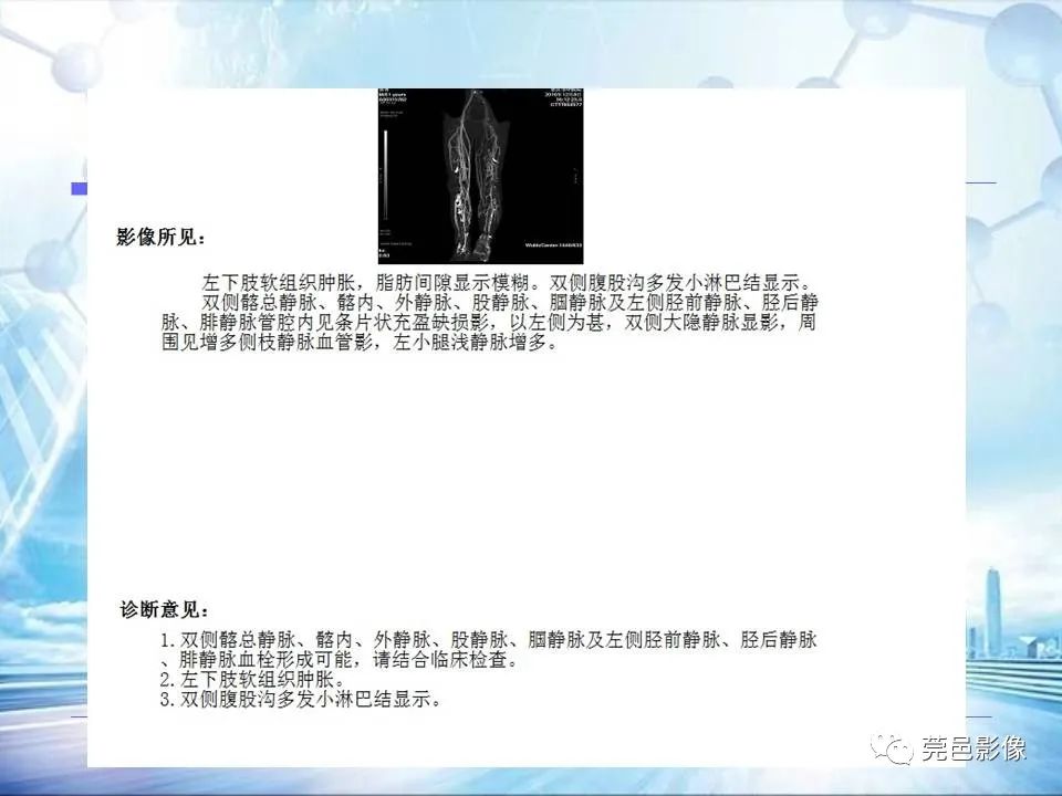 影像PPT - 【PPT】浅谈下肢静脉CTV的应用体会-30