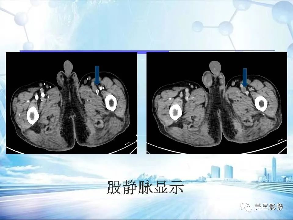 影像PPT - 【PPT】浅谈下肢静脉CTV的应用体会-29
