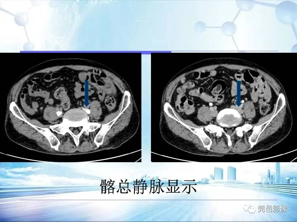 影像PPT - 【PPT】浅谈下肢静脉CTV的应用体会-27