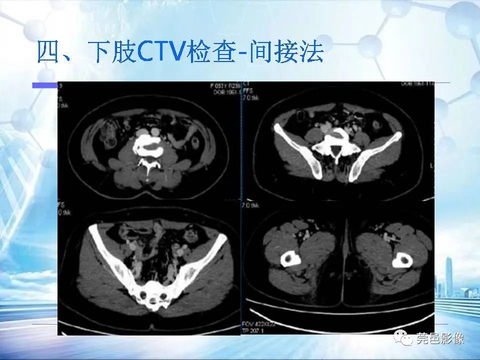 影像PPT - 【PPT】浅谈下肢静脉CTV的应用体会-33
