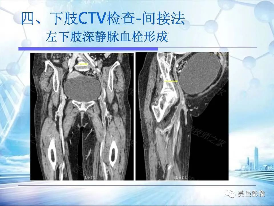 影像PPT - 【PPT】浅谈下肢静脉CTV的应用体会-35