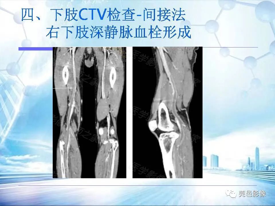 影像PPT - 【PPT】浅谈下肢静脉CTV的应用体会-36