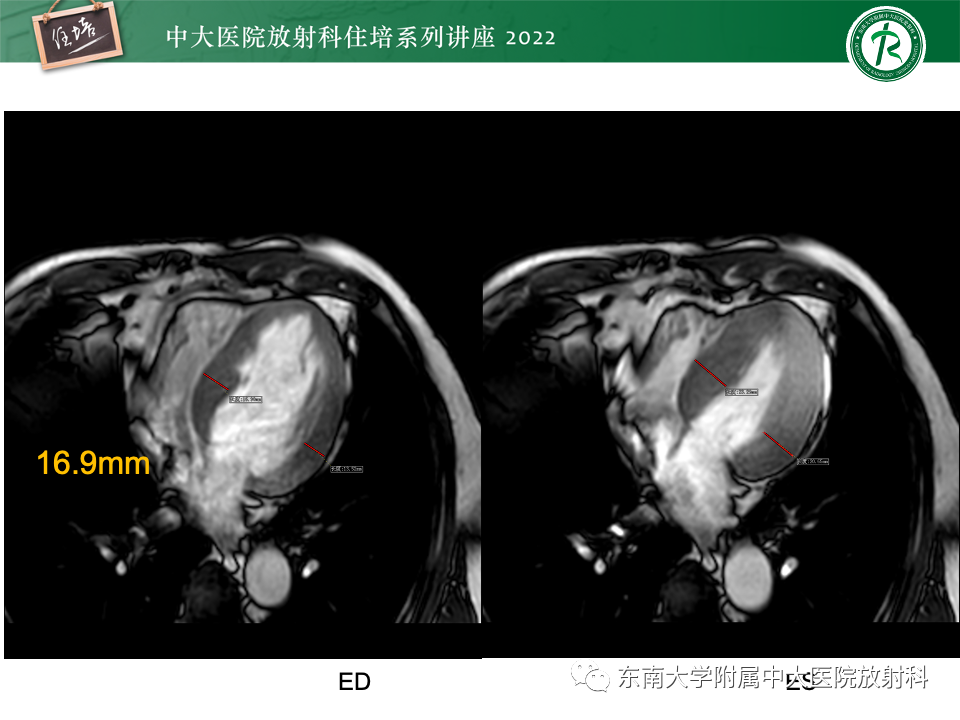 影像PPT - 【PPT】左心室肥厚的MR诊断及鉴别诊断思路-8