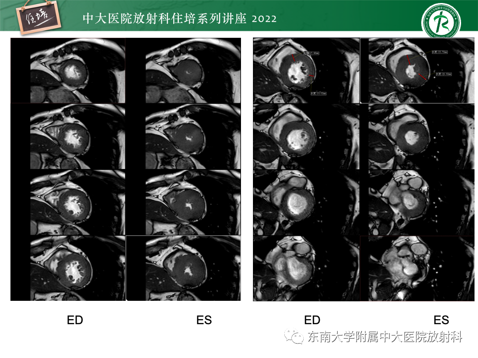 影像PPT - 【PPT】左心室肥厚的MR诊断及鉴别诊断思路-9