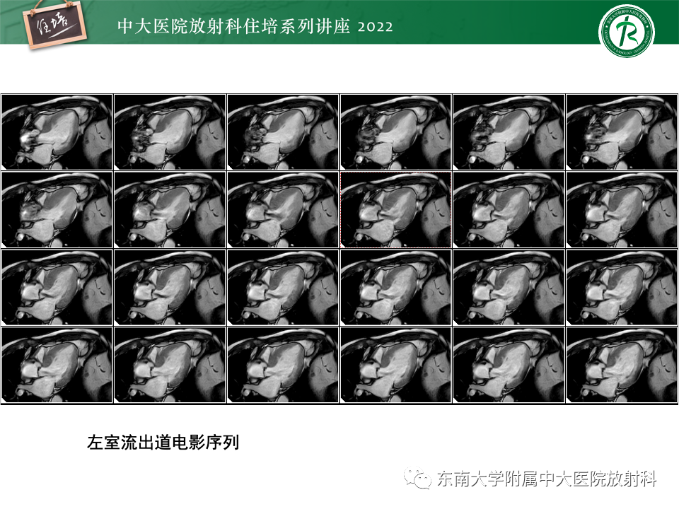 影像PPT - 【PPT】左心室肥厚的MR诊断及鉴别诊断思路-10