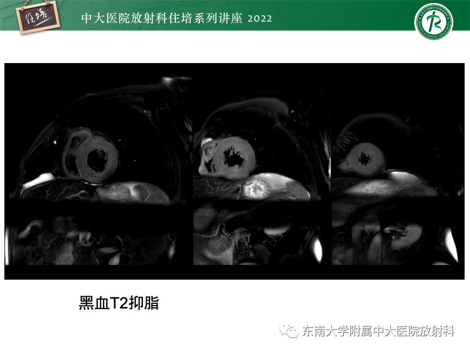影像PPT - 【PPT】左心室肥厚的MR诊断及鉴别诊断思路-11
