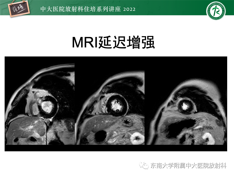影像PPT - 【PPT】左心室肥厚的MR诊断及鉴别诊断思路-12