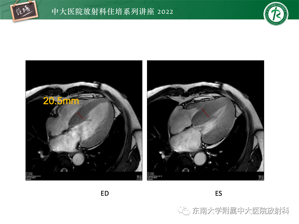 影像PPT - 【PPT】左心室肥厚的MR诊断及鉴别诊断思路-21