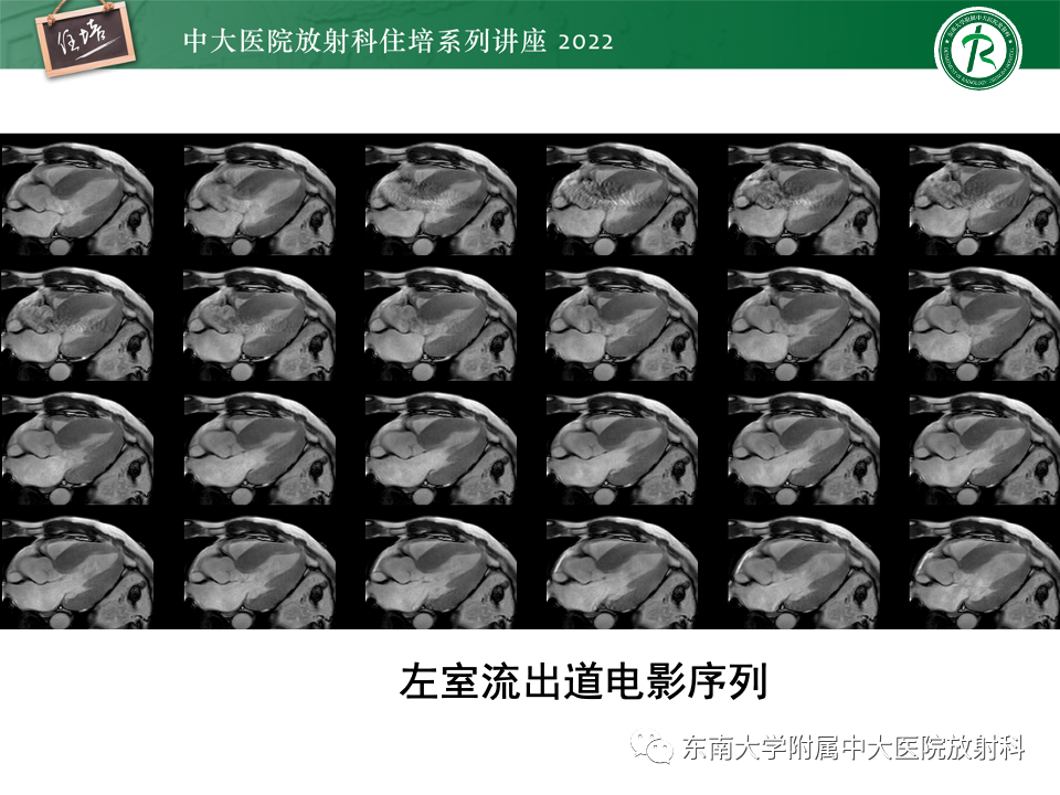 影像PPT - 【PPT】左心室肥厚的MR诊断及鉴别诊断思路-23