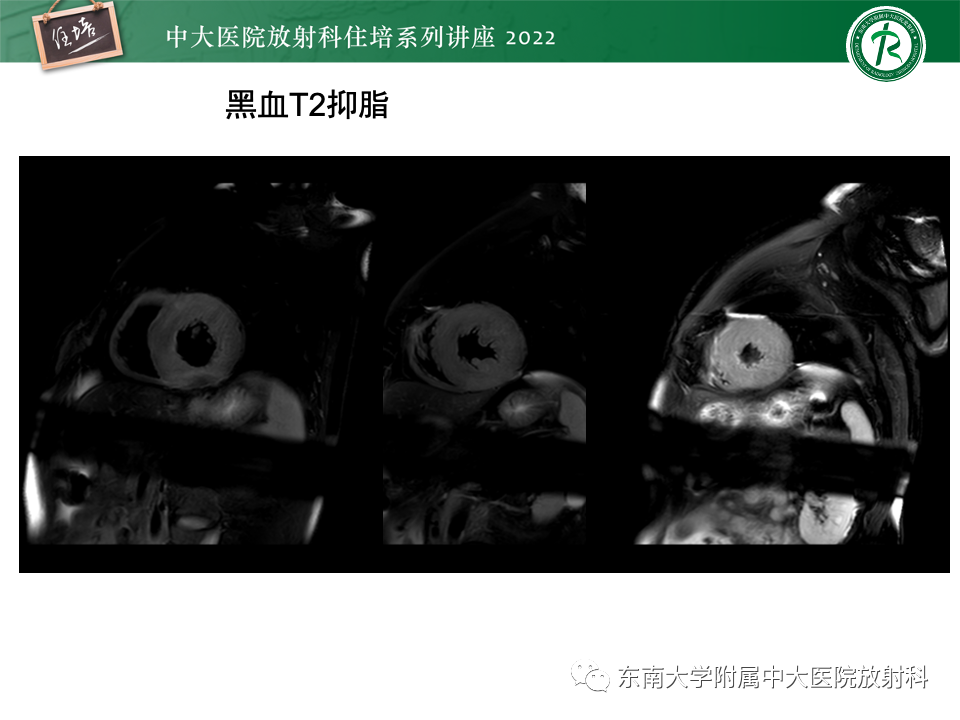 影像PPT - 【PPT】左心室肥厚的MR诊断及鉴别诊断思路-24