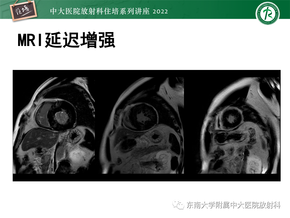 影像PPT - 【PPT】左心室肥厚的MR诊断及鉴别诊断思路-25