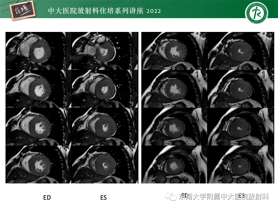 影像PPT - 【PPT】左心室肥厚的MR诊断及鉴别诊断思路-22