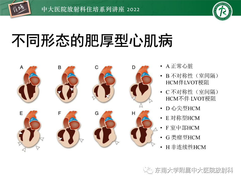 影像PPT - 【PPT】左心室肥厚的MR诊断及鉴别诊断思路-29