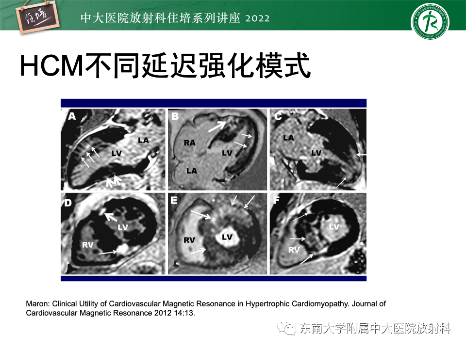 影像PPT - 【PPT】左心室肥厚的MR诊断及鉴别诊断思路-30