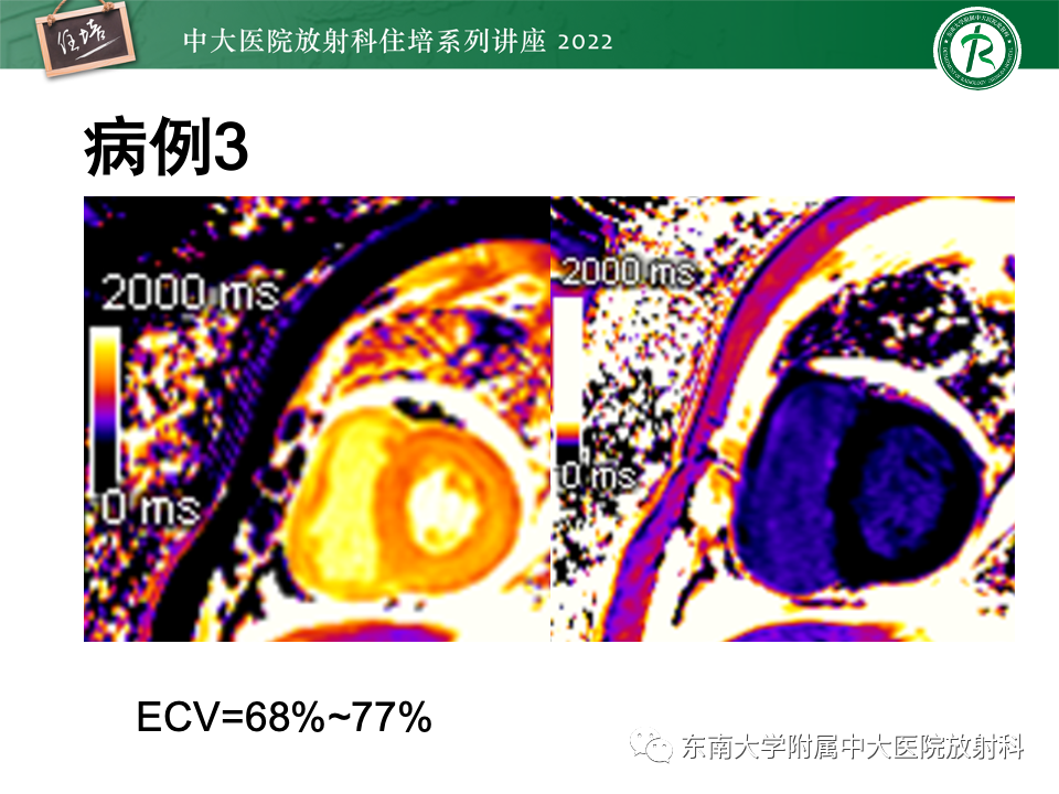影像PPT - 【PPT】左心室肥厚的MR诊断及鉴别诊断思路-33