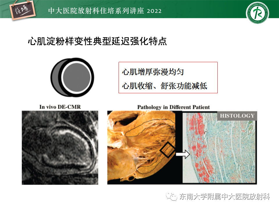 影像PPT - 【PPT】左心室肥厚的MR诊断及鉴别诊断思路-34