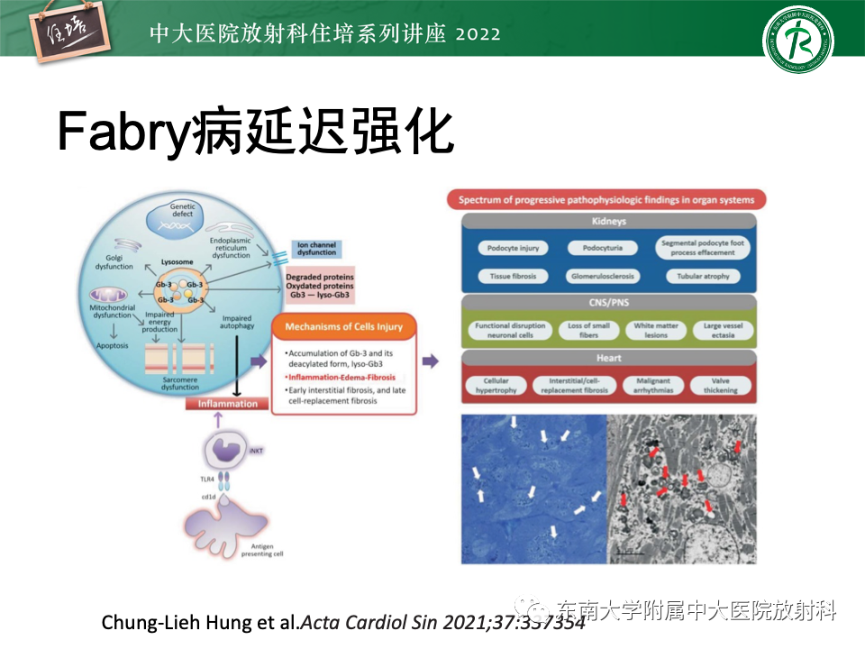 影像PPT - 【PPT】左心室肥厚的MR诊断及鉴别诊断思路-41