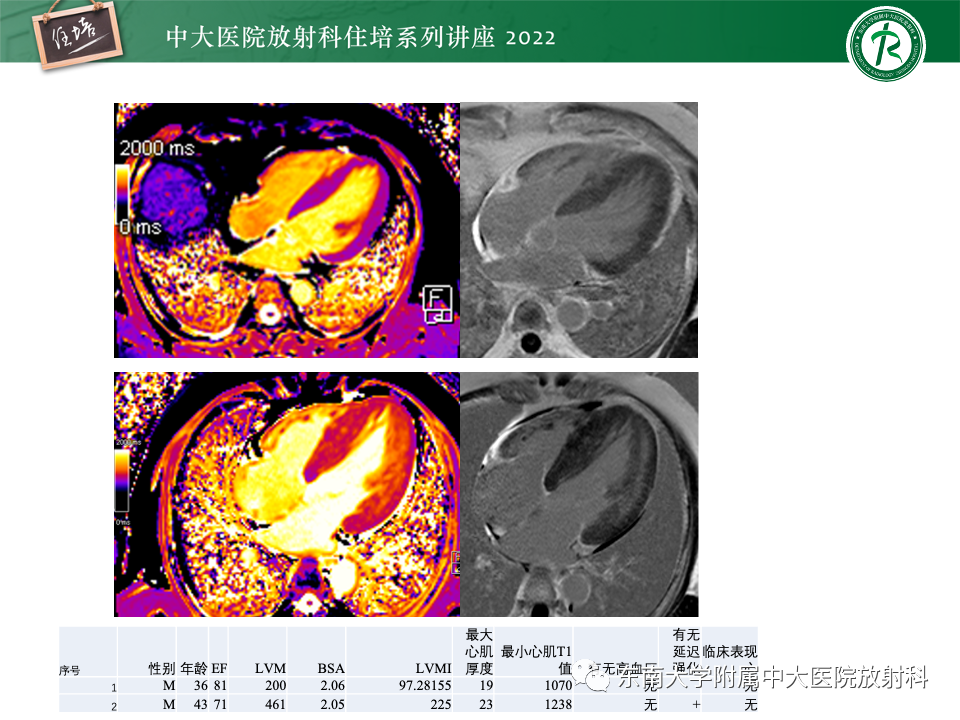 影像PPT - 【PPT】左心室肥厚的MR诊断及鉴别诊断思路-43