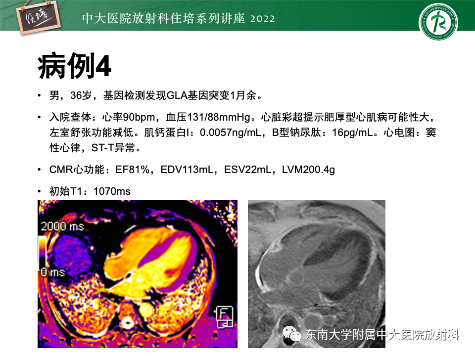 影像PPT - 【PPT】左心室肥厚的MR诊断及鉴别诊断思路-40