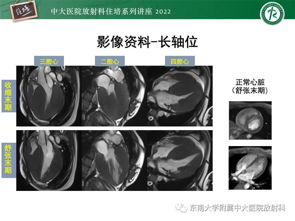 影像PPT - 【PPT】左心室肥厚的MR诊断及鉴别诊断思路-48