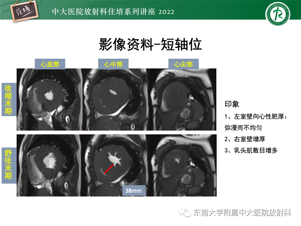 影像PPT - 【PPT】左心室肥厚的MR诊断及鉴别诊断思路-49