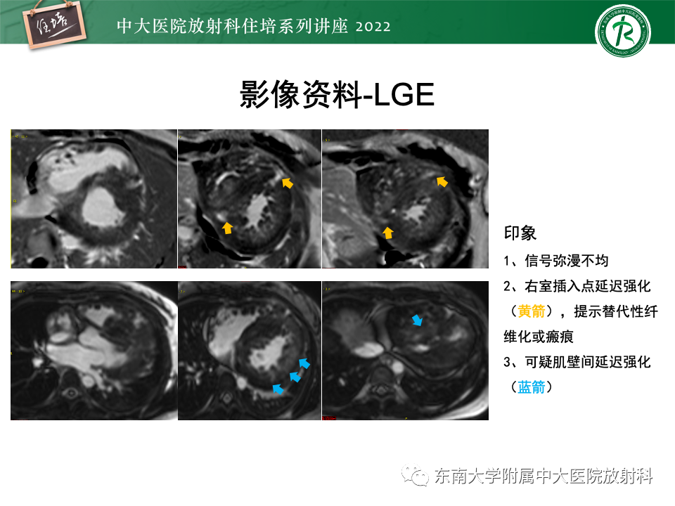 影像PPT - 【PPT】左心室肥厚的MR诊断及鉴别诊断思路-53