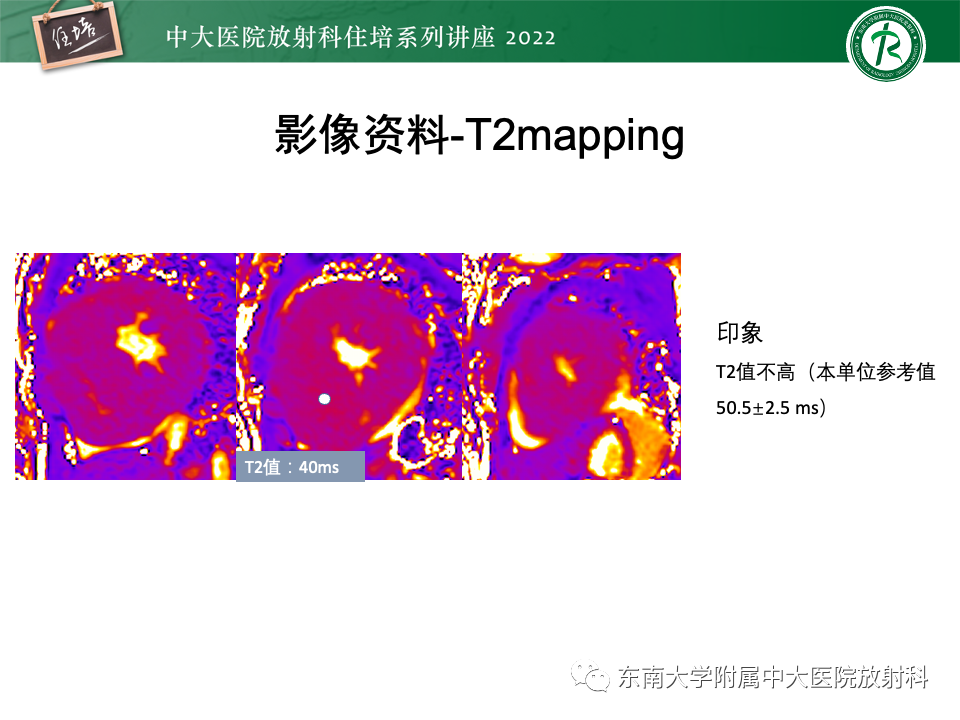 影像PPT - 【PPT】左心室肥厚的MR诊断及鉴别诊断思路-52