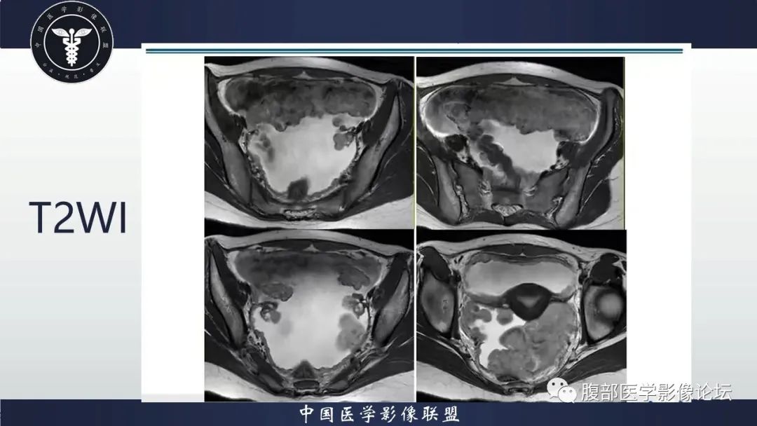 影像PPT - 【病例】盆腔上皮样炎性肌纤维母细胞肉瘤1例MR-5