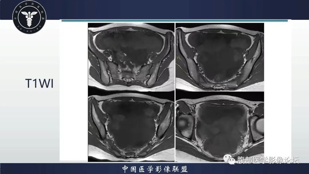 影像PPT - 【病例】盆腔上皮样炎性肌纤维母细胞肉瘤1例MR-4