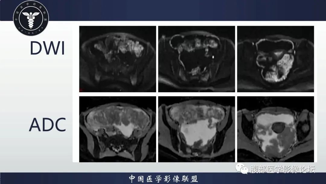 影像PPT - 【病例】盆腔上皮样炎性肌纤维母细胞肉瘤1例MR-6