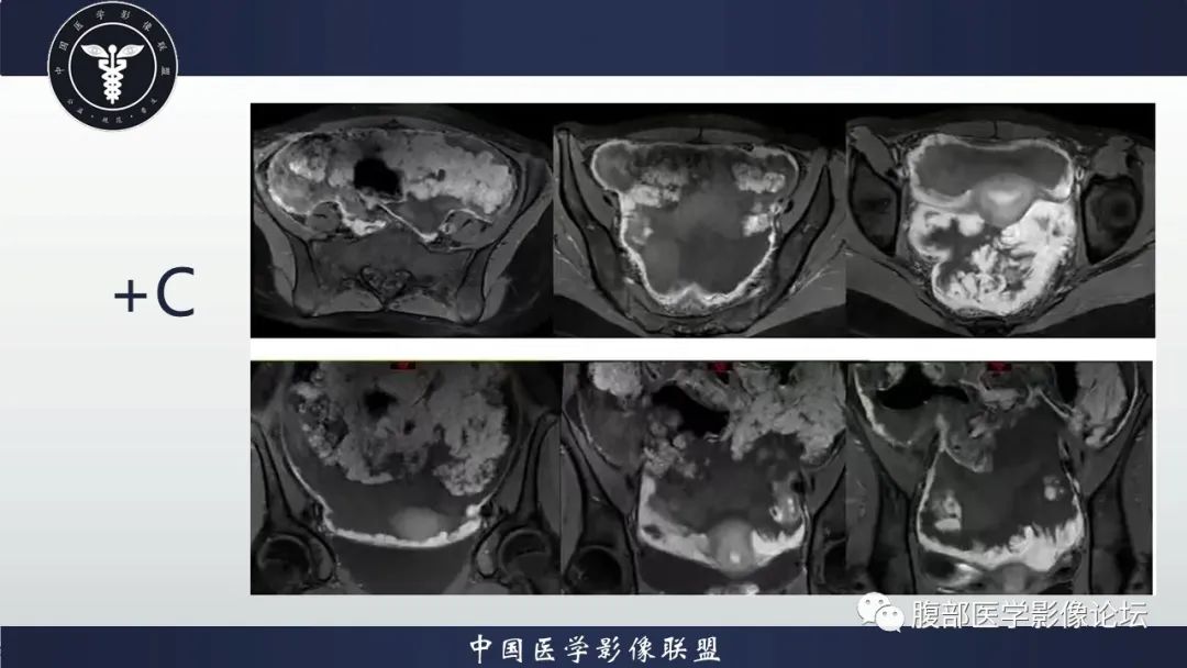 影像PPT - 【病例】盆腔上皮样炎性肌纤维母细胞肉瘤1例MR-7