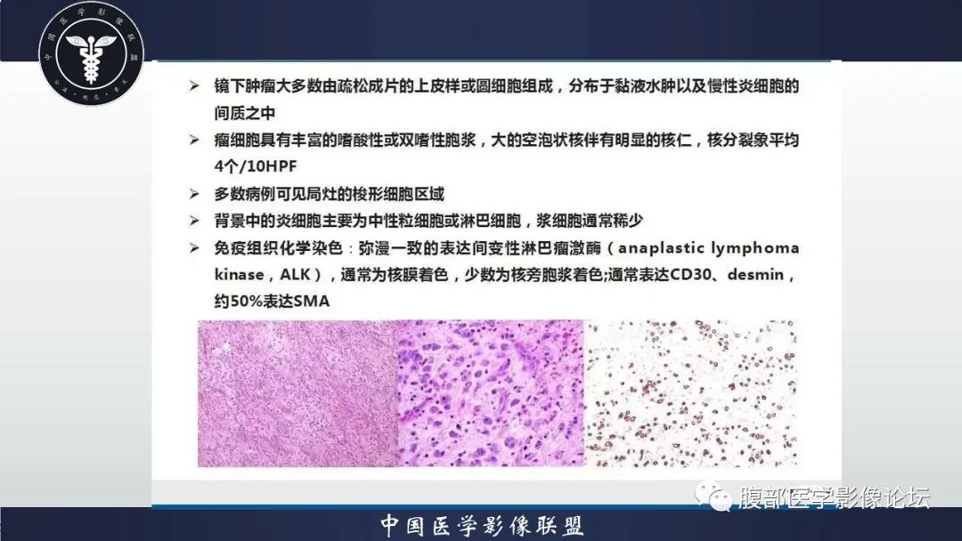 影像PPT - 【病例】盆腔上皮样炎性肌纤维母细胞肉瘤1例MR-10