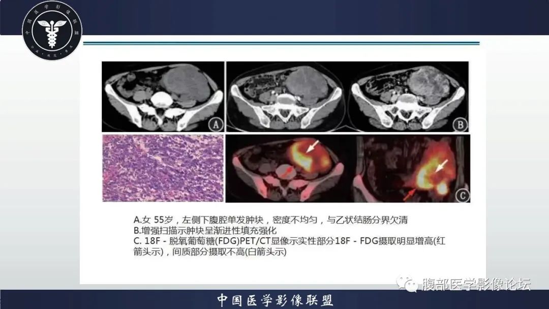 影像PPT - 【病例】盆腔上皮样炎性肌纤维母细胞肉瘤1例MR-11