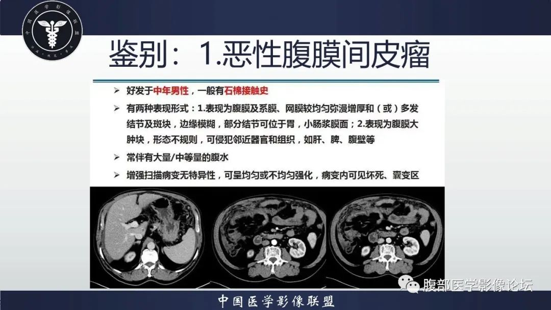 影像PPT - 【病例】盆腔上皮样炎性肌纤维母细胞肉瘤1例MR-14