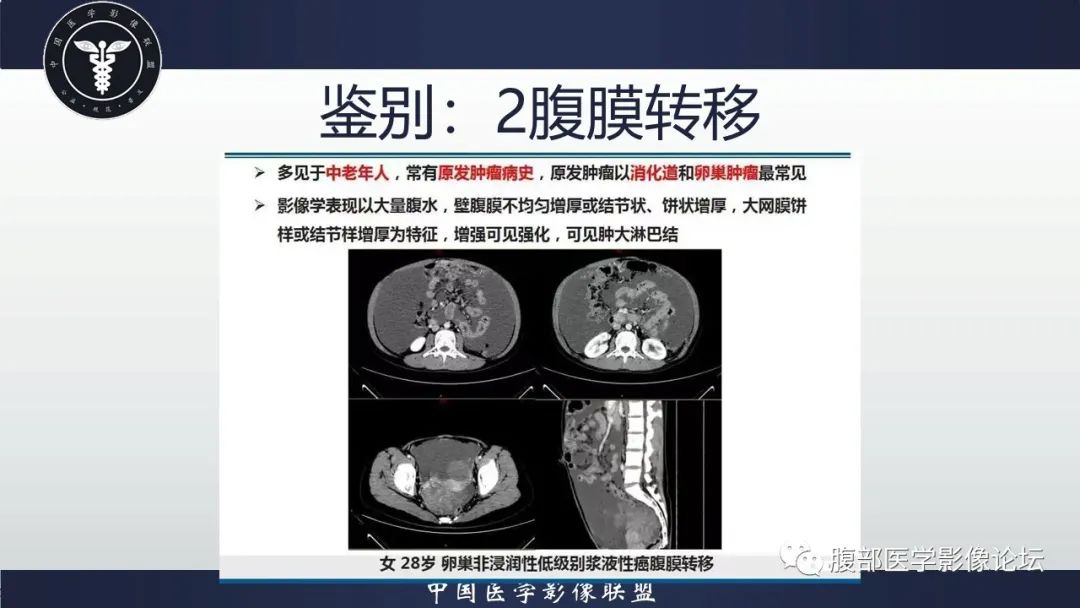 影像PPT - 【病例】盆腔上皮样炎性肌纤维母细胞肉瘤1例MR-15