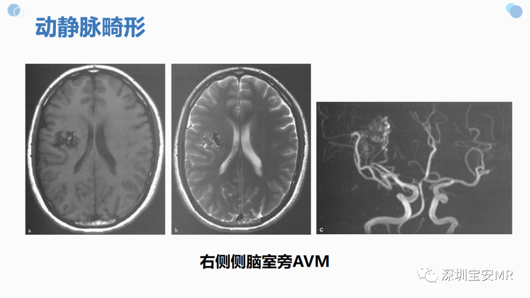 影像PPT - 【PPT】中枢神经系统血管畸形-10