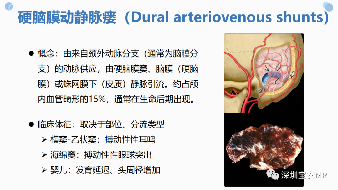 影像PPT - 【PPT】中枢神经系统血管畸形-11