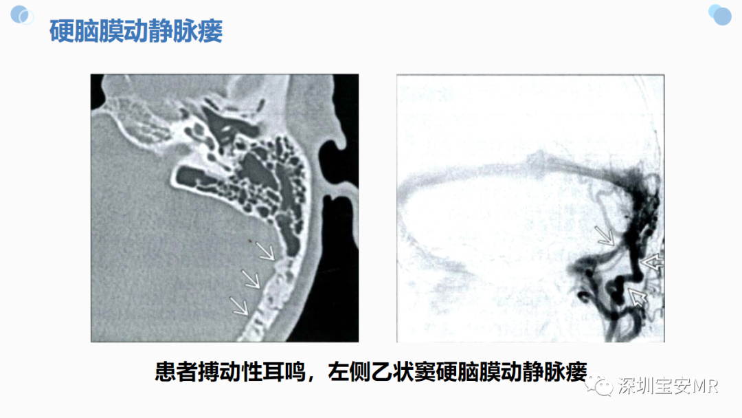影像PPT - 【PPT】中枢神经系统血管畸形-13
