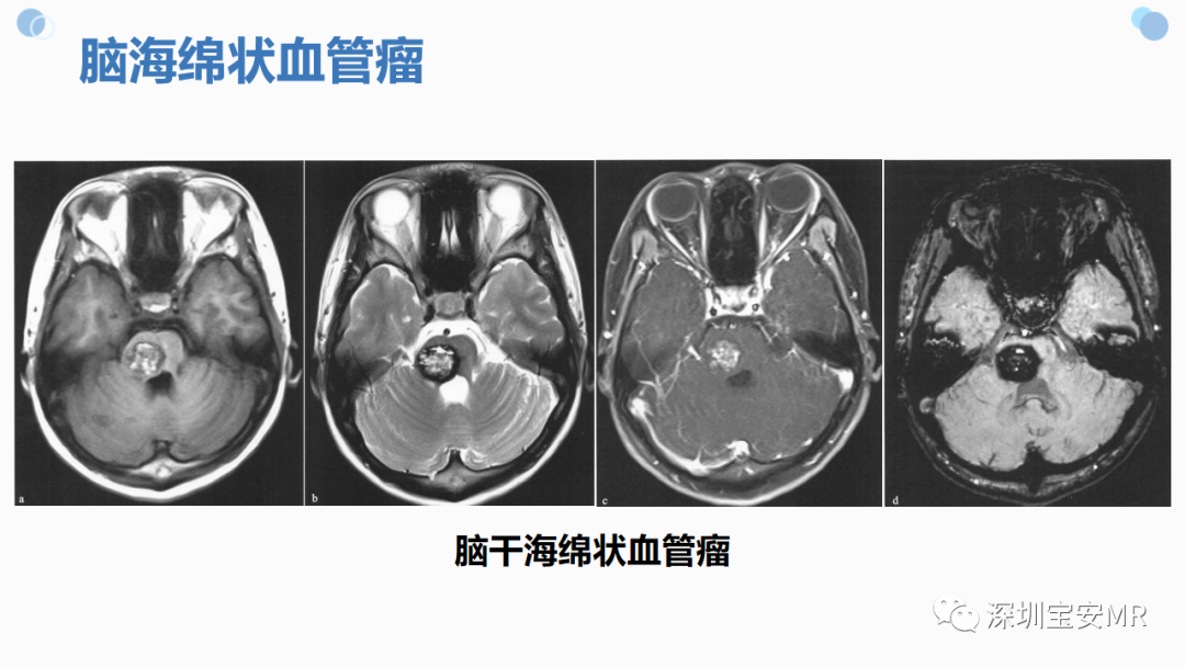 影像PPT - 【PPT】中枢神经系统血管畸形-18